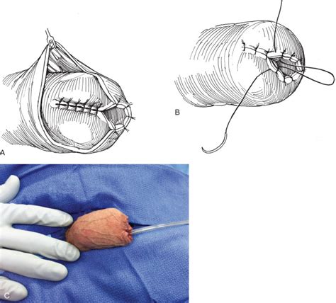 Penectomy 